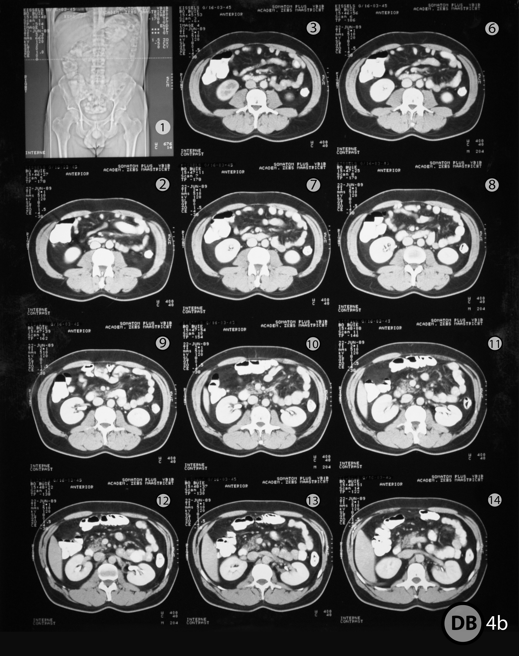 CT Abdomen Transvers 1 AnatomyTOOL